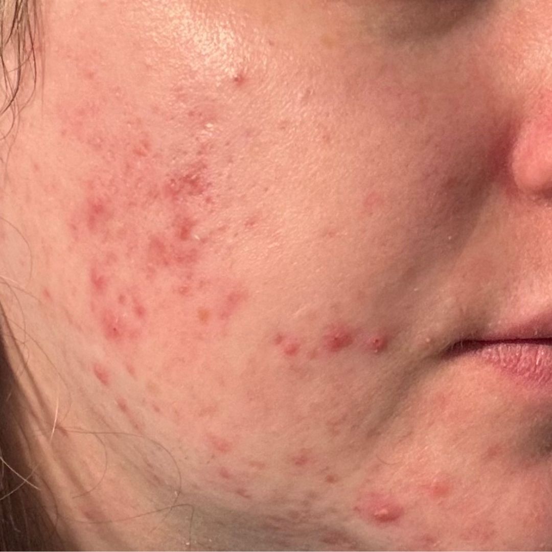 Customized Acne Facials & Skin Health Support at Iridescence Salon & Spa