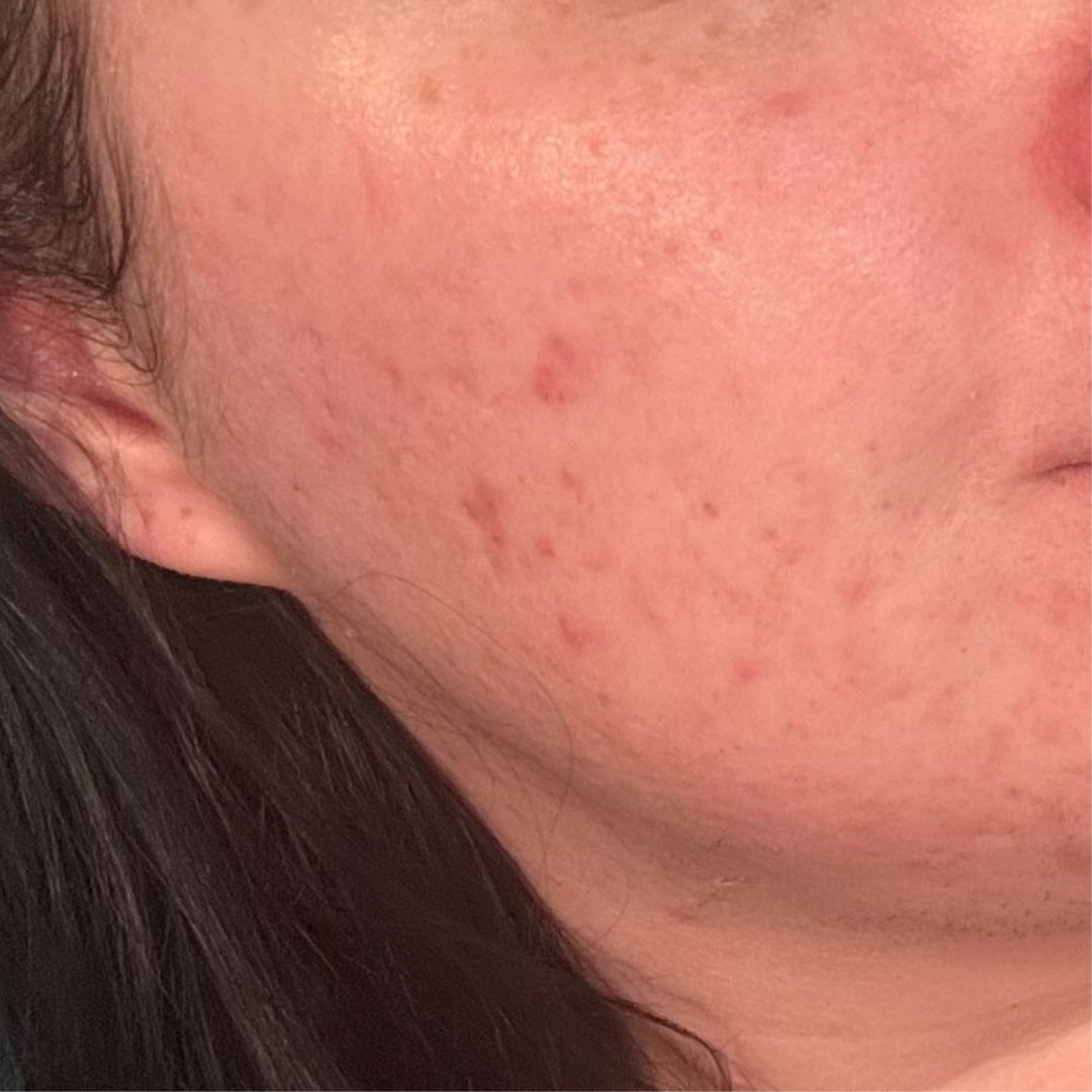 Customized Acne Facials & Skin Health Support at Iridescence Salon & Spa